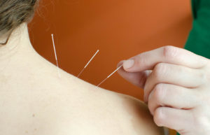 Acupuncture Monroeville PA